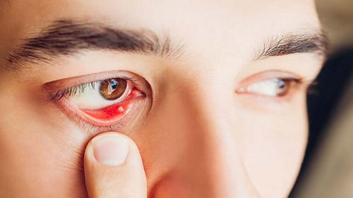 Triệu chứng của mọc lẹo ở mắt